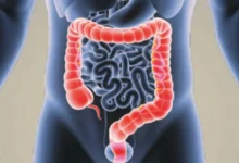 Photo of কোলন ক্যান্সার কীভাবে বুঝবেন